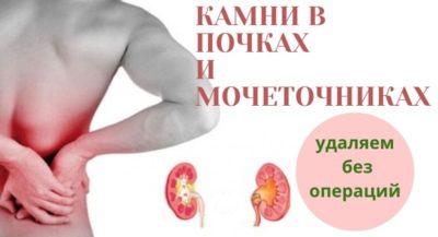 камни в почках